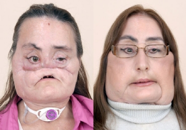 un-hospital-ee-uu-presenta-paciente-80-ciento-rostro-trasplantado